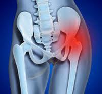 Wright Profemur Hip Replacement: Adverse events